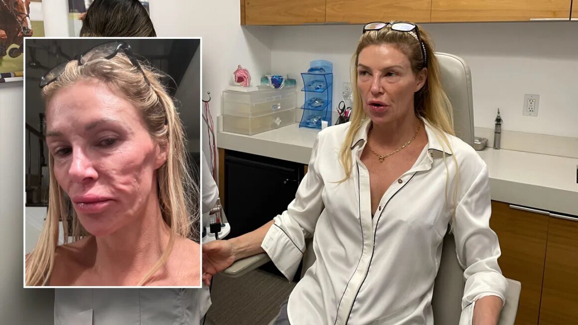 Brandi Glanville thinks parasite attacked face as ‘Botched’ doc Terry Dubrow calls her ‘ticking time bomb’